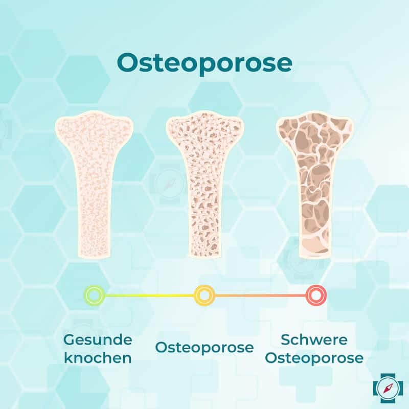 Osteoporose